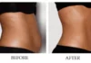 Green Laser Fat Reduction: Everything You Need to Know